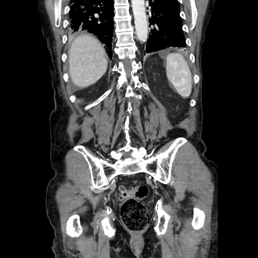 Closed loop small bowel obstruction - adhesive disease and hemorrhagic ischemia (Radiopaedia 86831-102990 B 100).jpg