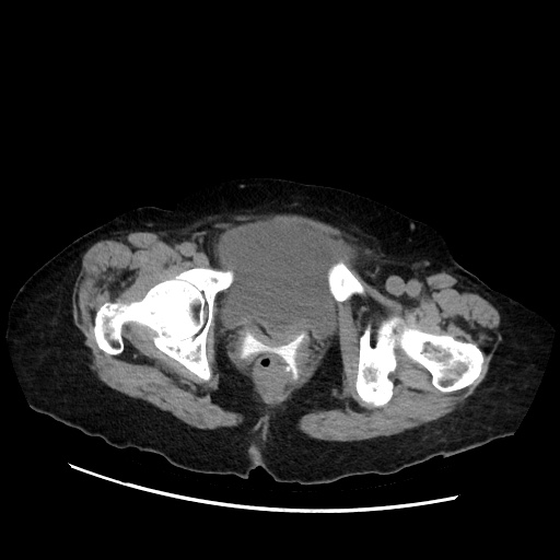 File:Closed loop small bowel obstruction due to adhesive band, with intramural hemorrhage and ischemia (Radiopaedia 83831-99017 Axial non-contrast 153).jpg