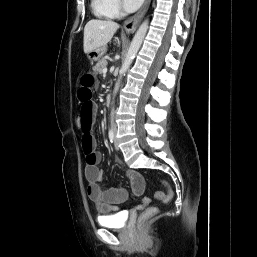 Closed loop small bowel obstruction due to adhesive bands - early and late images (Radiopaedia 83830-99015 C 92).jpg