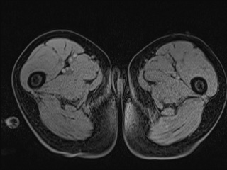 Closed loop small bowel obstruction in pregnancy (MRI) (Radiopaedia 87637-104031 G 49).jpg