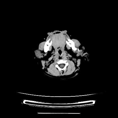 Cloverleaf skull (Radiopaedia 91901-109710 Axial non-contrast 31).jpg