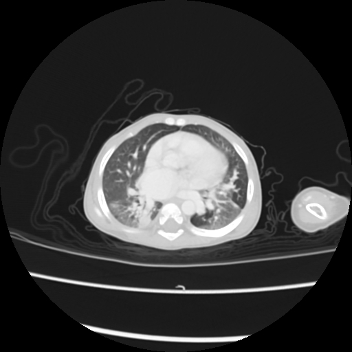 Coarctation of the aorta and patent ductus arteriosus (Radiopaedia 68033-77499 Axial lung window 30).jpg