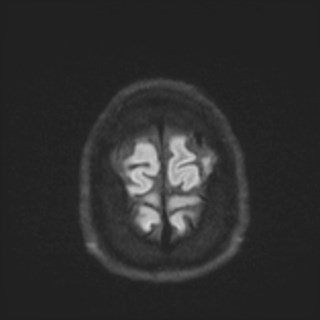 Cochlear incomplete partition type III associated with hypothalamic hamartoma (Radiopaedia 88756-105498 Axial DWI 79).jpg