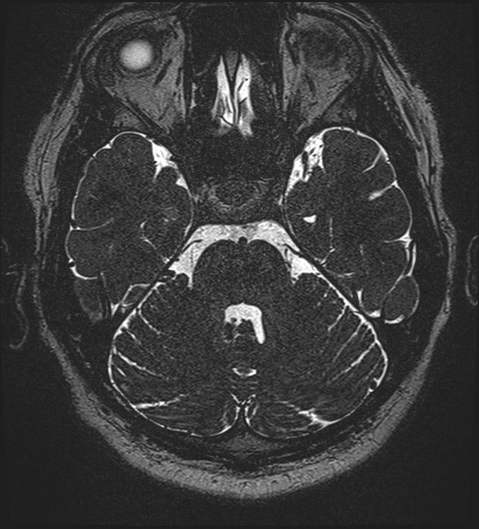 Cochlear incomplete partition type III associated with hypothalamic hamartoma (Radiopaedia 88756-105498 Axial T2 106).jpg