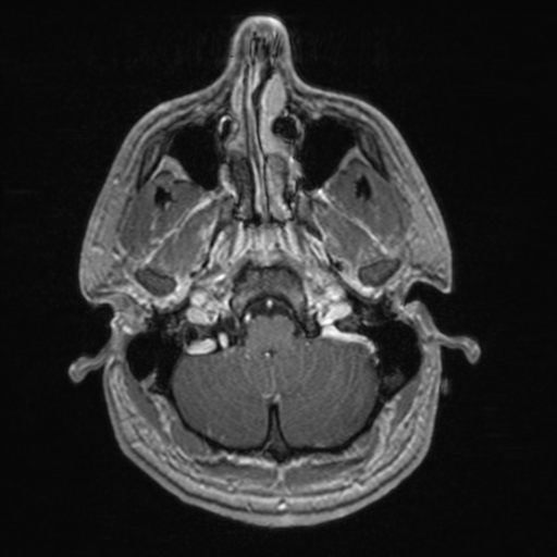 File:Colloid cyst (Radiopaedia 44510-48181 Axial T1 C+ 38).png