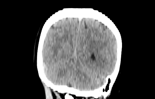 Colloid cyst (Radiopaedia 88663-105373 Coronal non-contrast 54).jpg