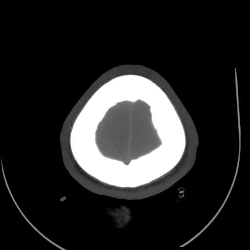 Colloid cyst (resulting in death) (Radiopaedia 33423-34499 A 54).png