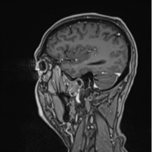 File:Colloid cyst of the third ventricle (Radiopaedia 86571-102662 Sagittal T1 C+ 19).png