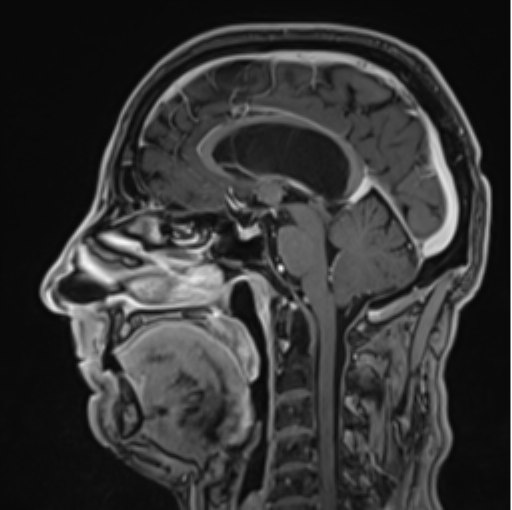 File:Colloid cyst of the third ventricle (Radiopaedia 86571-102662 Sagittal T1 C+ 40).png