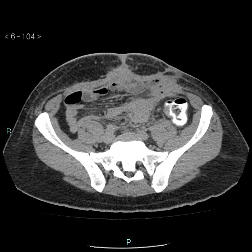 File:Colo-cutaneous fistula (Radiopaedia 40531-43129 A 43).jpg