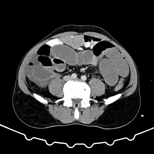 File:Colocolic intussusception due to large lipoma (Radiopaedia 68773-78482 A 120).jpg
