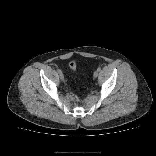 File:Colocutaneous fistula in Crohn's disease (Radiopaedia 29586-30093 Axial non-contrast 32).jpg