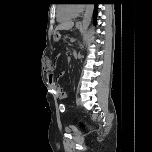 File:Colocutaneous fistula in Crohn's disease (Radiopaedia 29586-30093 F 23).jpg