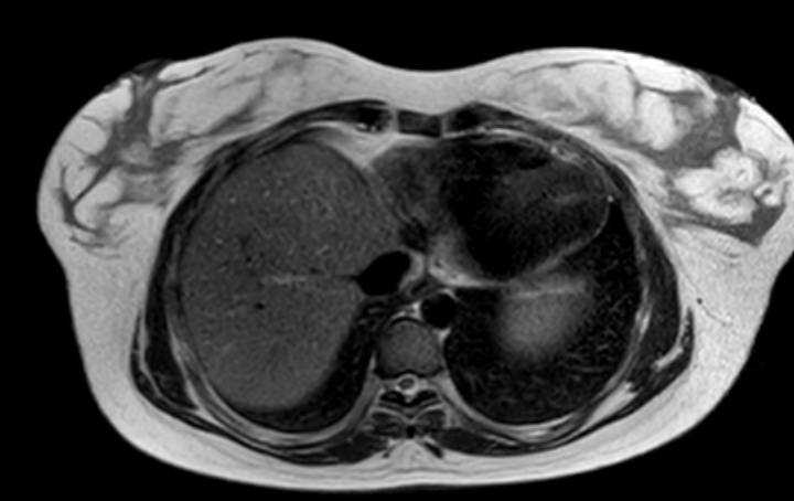 Colon adenocarcinoma with Krukenberg tumors, advanced pregnancy (Radiopaedia 67279-76645 Axial T2 78).jpg