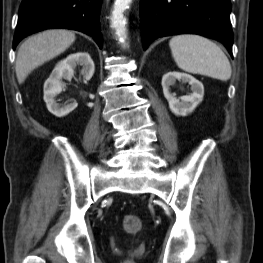 File:Colon cancer with duodenal invasion (Radiopaedia 16278-15958 B 42).jpg