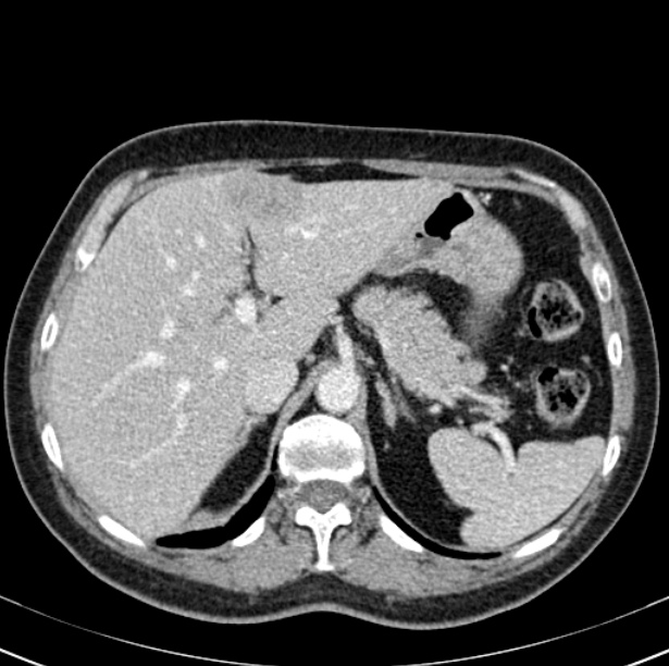 Colon carcinoma with hepatic metastases (Radiopaedia 29477-29961 A 28).jpg