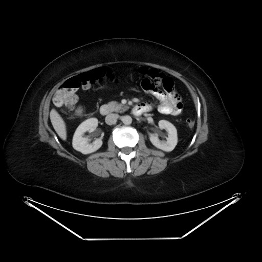 File:Colonic intussusception due to adenocarcinoma (Radiopaedia 86828-102987 A 64).jpg