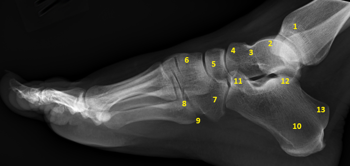 File:Foot - annotated lateral projection (Radiopaedia 44288).jpg