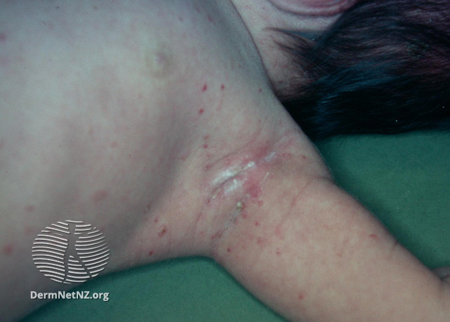 File:Histiocytosis (DermNet NZ dermal-infiltrative-langerhans).jpg