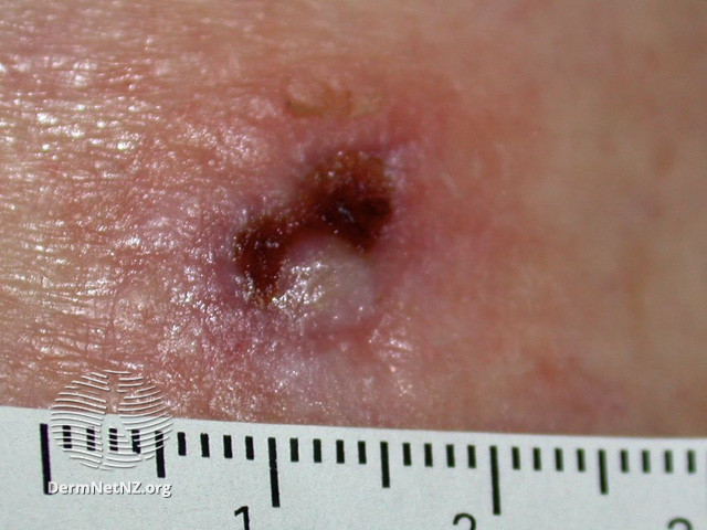 File:Intraepidermal carcinoma (DermNet NZ lesions-scc-in-situ-2933).jpg