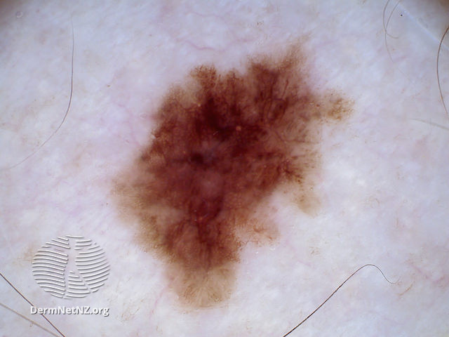 File:Melanoma in situ, polarised dermoscopy view (DermNet NZ 20131210115606365).jpg