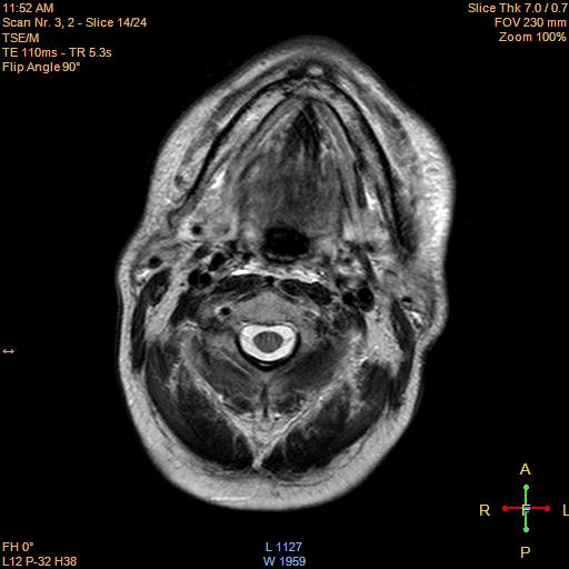 File:Nasopharyngeal carcinoma (Radiopaedia 22375-22403 Axial T2 11).jpg