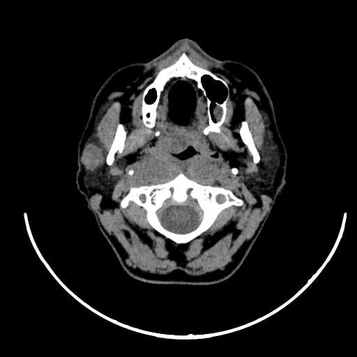 File:Nasopharyngeal carcinoma - infiltrating the clivus (Radiopaedia 62583-70875 Axial non-contrast 22).jpg
