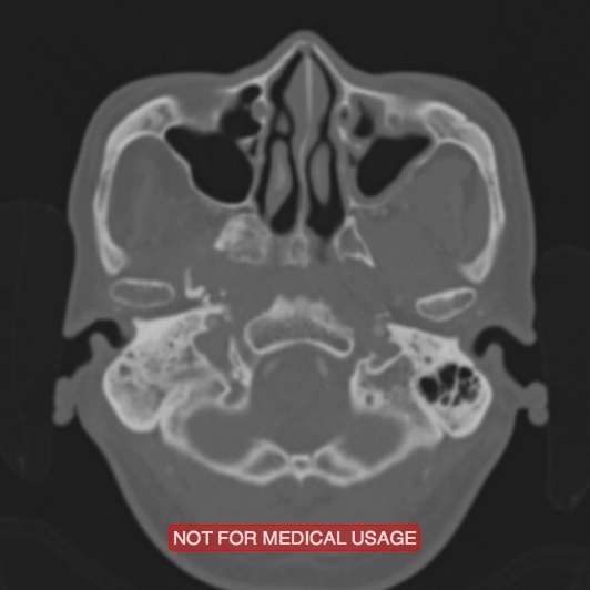 Nasopharyngeal carcinoma recurrence - skull base destruction (Radiopaedia 29107-29490 Axial bone window 91).jpg