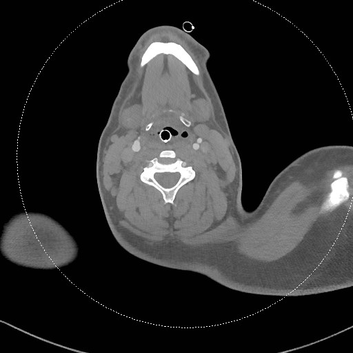 Neck CT angiogram (intraosseous vascular access) (Radiopaedia 55481-61945 B 182).jpg