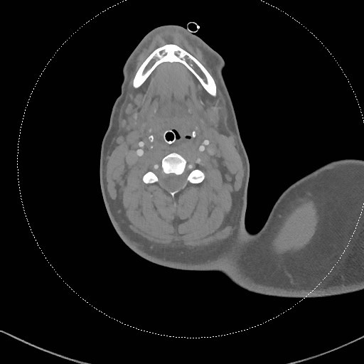 Neck CT angiogram (intraosseous vascular access) (Radiopaedia 55481-61945 B 189).jpg