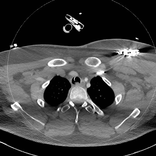 Neck CT angiogram (intraosseous vascular access) (Radiopaedia 55481-61945 B 85).jpg
