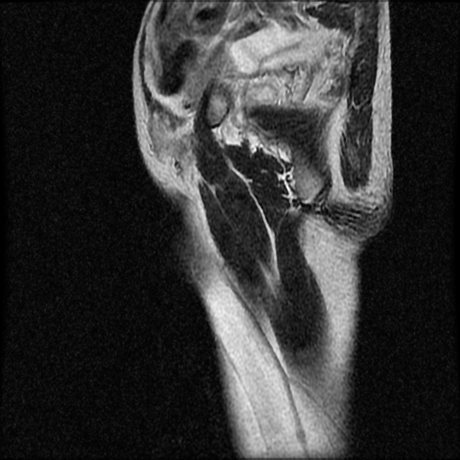 File:Necrotizing epididymo-orchitis with intra-testicular abscess (Radiopaedia 29397-29860 Sagittal T2 17).jpg