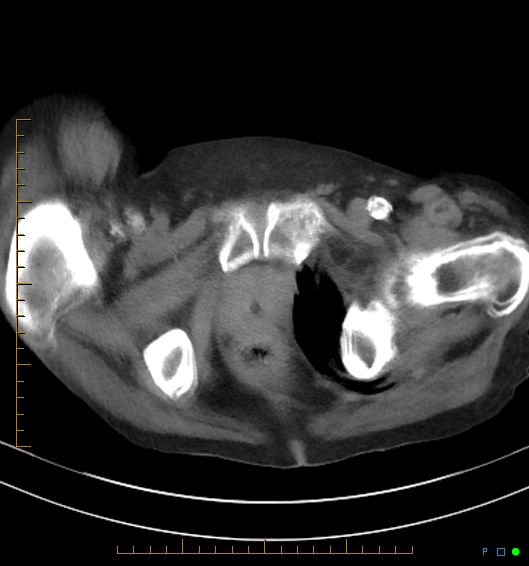 Necrotzing fasciitis due to a perforated adenocarcinoma of the splenic flexure (Radiopaedia 46930-51455 A 64).jpg