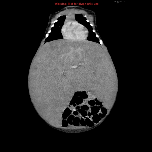 File:Neonatal neuroblastoma (Radiopaedia 9564-10223 B 45).jpg
