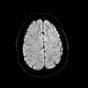 File:Neuro-Behcet's disease (Radiopaedia 21557-21506 Axial DWI 21).jpg