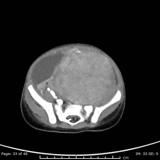 File:Neuroblastoma (Radiopaedia 41472-44355 A 33).jpg