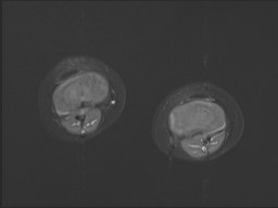 File:Neuroblastoma with bone metastases (Radiopaedia 67080-76414 Axial STIR 3).jpg