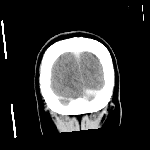 Neurocysticercosis - granular nodular (Radiopaedia 42786-45957 Coronal C+ 60).png