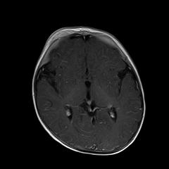 File:Neurofibromatosis type 1 (Radiopaedia 30089-30671 Axial T1 C+ 12).jpg