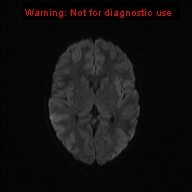 File:Neurofibromatosis type 1 with optic nerve glioma (Radiopaedia 16288-15965 Axial DWI 59).jpg