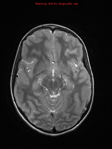 File:Neurofibromatosis type 1 with optic nerve glioma (Radiopaedia 16288-15965 Axial T2 15).jpg