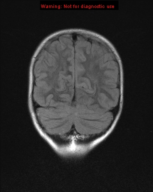 File:Neurofibromatosis type 1 with optic nerve glioma (Radiopaedia 16288-15965 Coronal FLAIR 5).jpg