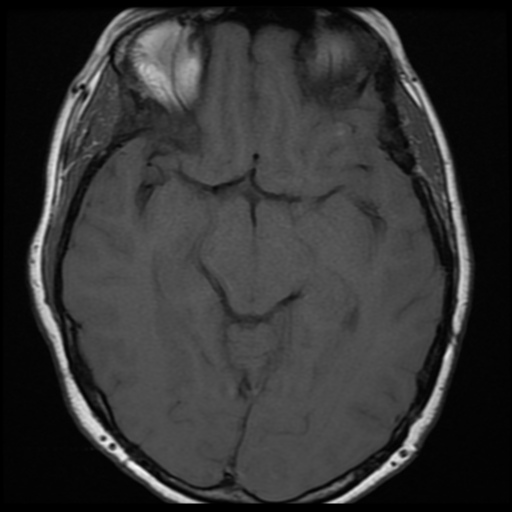 File:Neurofibromatosis type 2 (Radiopaedia 45229-49251 Axial T1 16).png