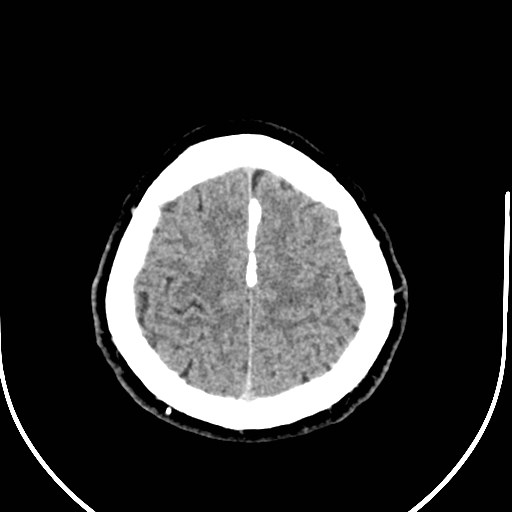 Neurofibromatosis type 2 (Radiopaedia 79097-92047 Axial non-contrast 52).jpg
