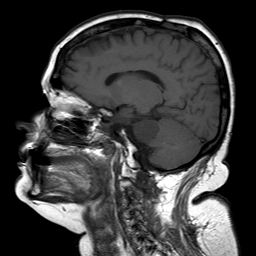 File:Neurofibromatosis type 2 (Radiopaedia 8713-9518 Sagittal T1 12).jpg