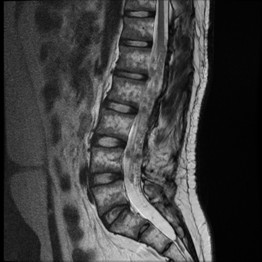 File:Neurofibromatosis type 2 (spinal manifestations) (Radiopaedia 53943-60070 E 8).png