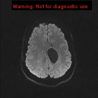 File:Neuroglial cyst (Radiopaedia 10713-11184 Axial DWI 31).jpg