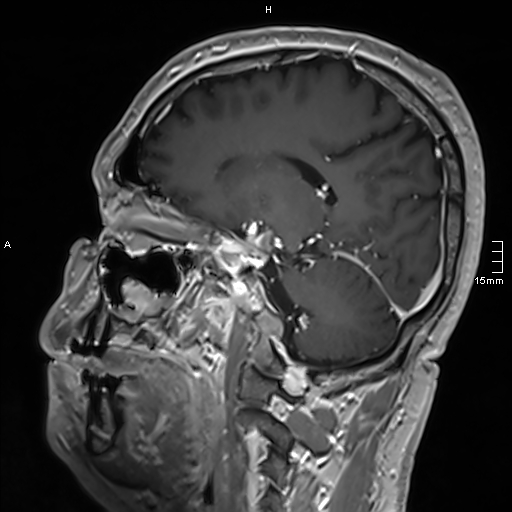Neurosarcoidosis - involvement of the mesial temporal lobes (Radiopaedia 67429-76820 Sagittal T1 C+ 101).jpg
