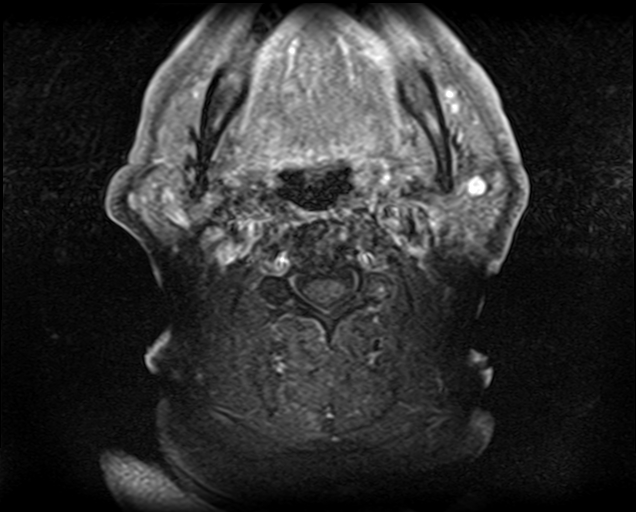 File:Non-Hodgkin lymphoma - parotid gland (Radiopaedia 71531-81890 Axial T1 C+ fat sat 9).jpg
