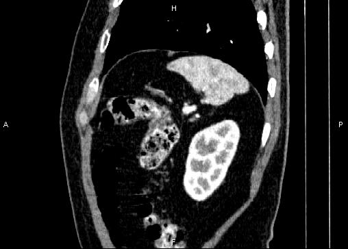 Non-syndromic pancreatic endocrine tumor (Radiopaedia 86958-103178 E 85).jpg